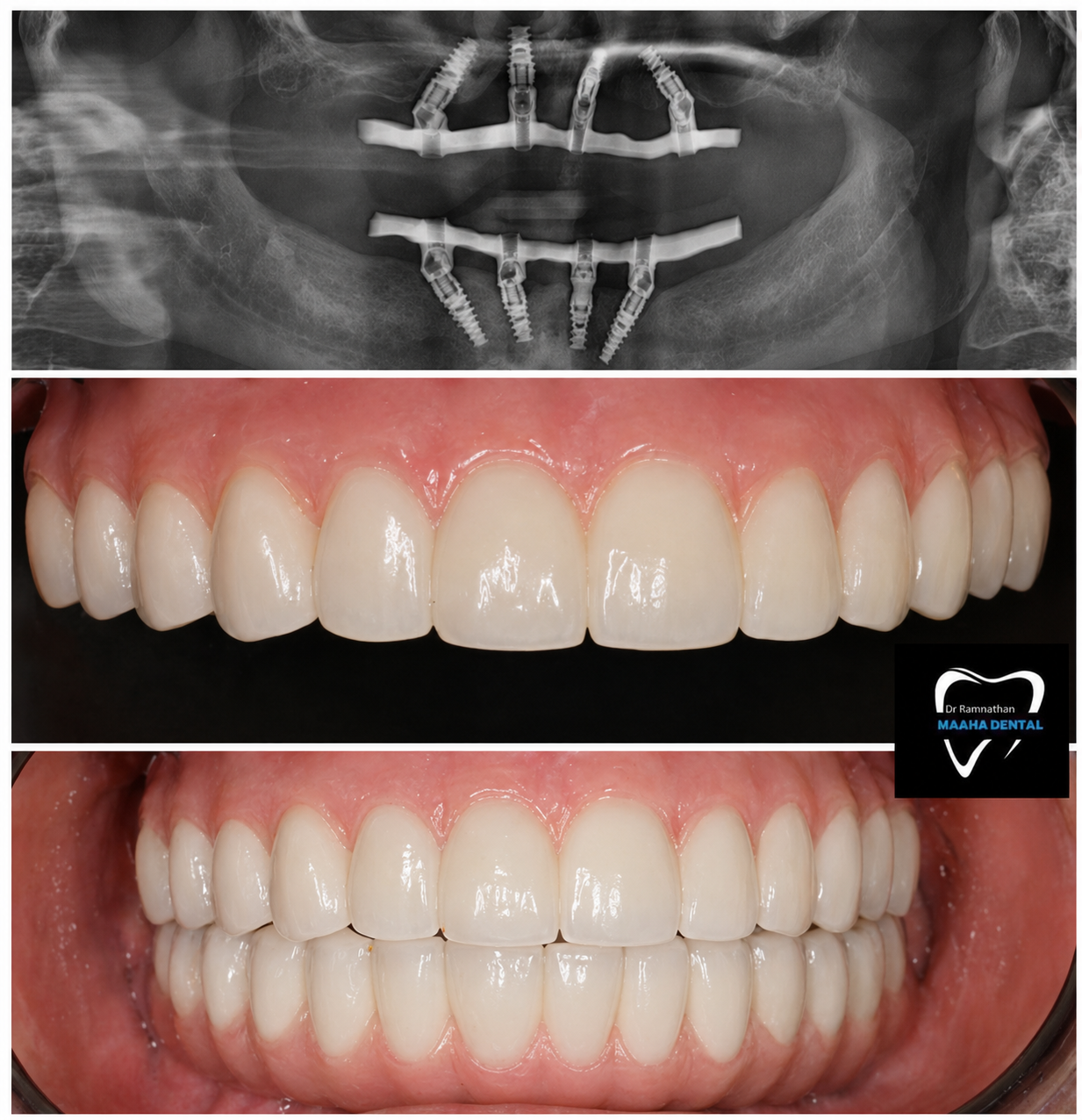 Full Mouth Rehabilitation